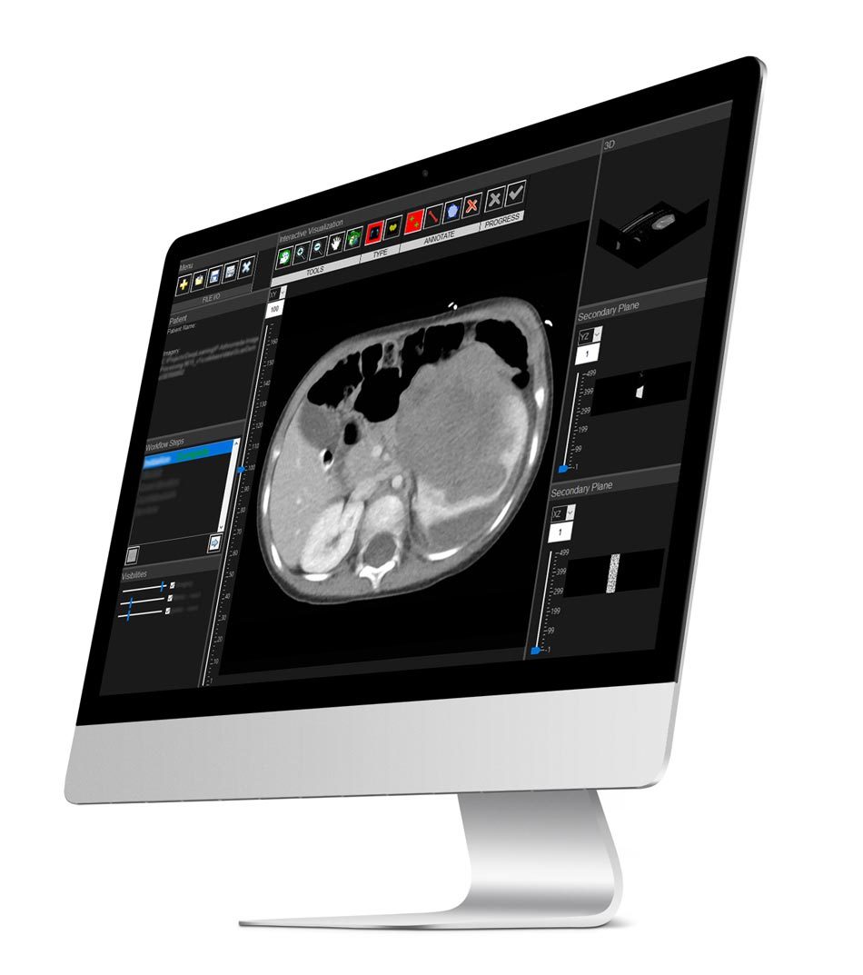 在计算机屏幕上在matlab处理的医学图象。