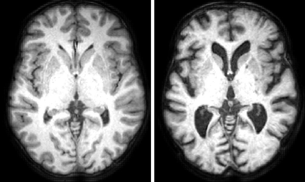 结构MRI图像通过典型的健康19岁和典型健康86岁的大脑显示水平部分。