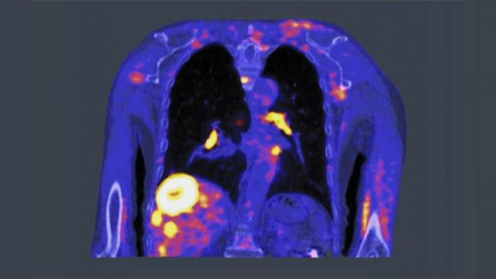 PET扫描使用少量被称为示踪剂的放射性药物来突出癌细胞