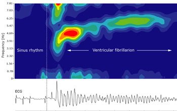 图4.心室颤动的时频分析。3-6Hz范围内的频率峰值表示心室颤动或颤振。