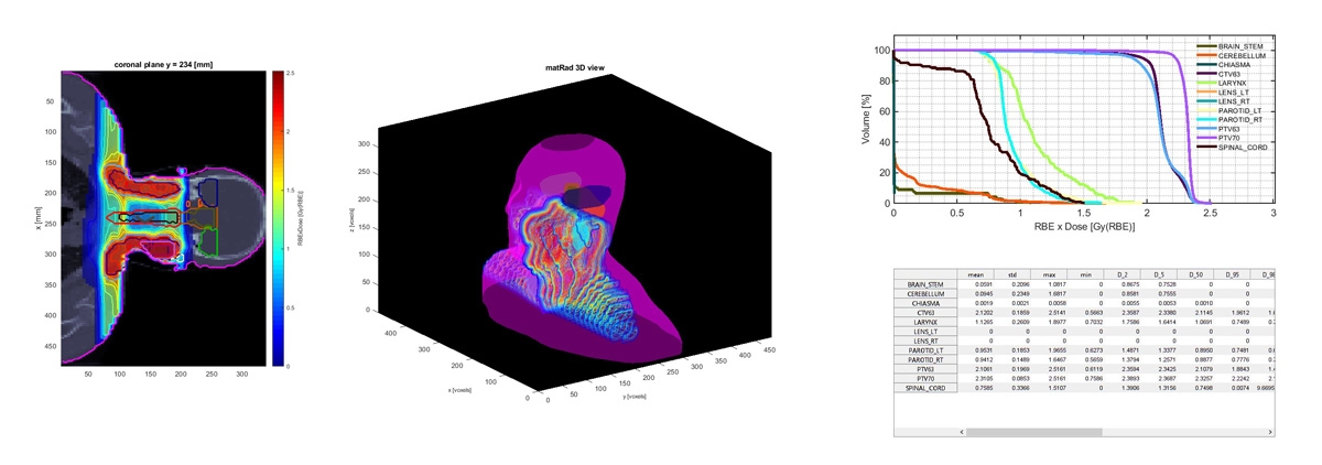 图4.在matrad中生成的可视化。左：CT和计划的质子剂量在头颈癌壳体的冠状平面中。中心：3D渲染相同的可视化。右：样品剂量直方图和统计表。