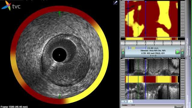 The TVC Imaging System user interface, with visualization tools for transverse IVUS, chemogram, and longitudinal IVUS.