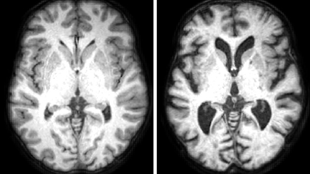 加速神经影像数据的分析研究健康的认知老化