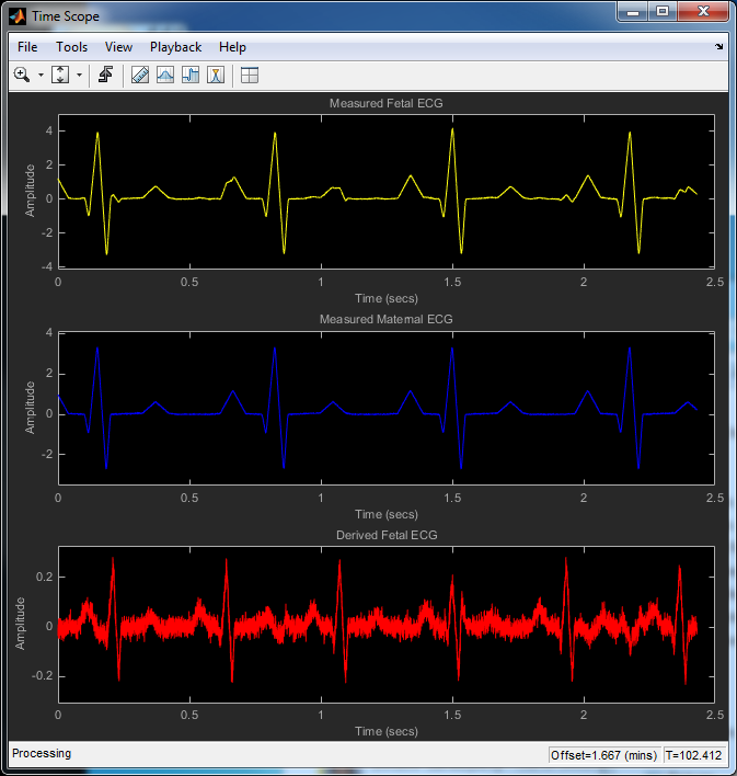自适应噪声消除（ANC）应用于胎儿心电图