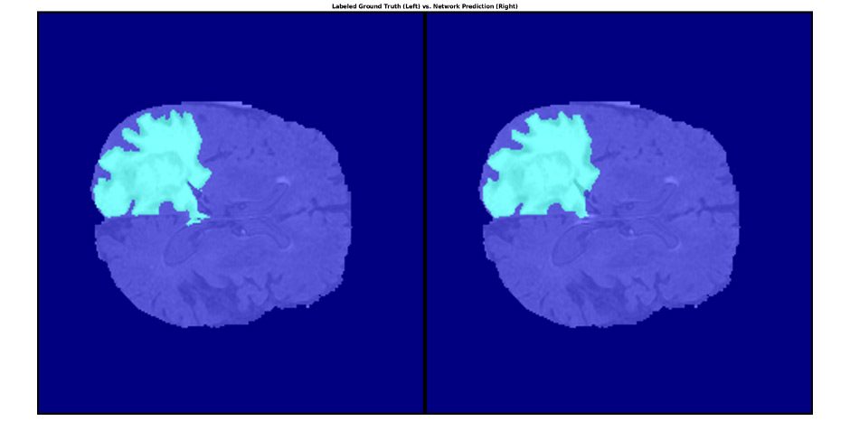 用MATLAB对脑组织肿瘤进行分割，左图标注ground truth，右图标注network prediction。
