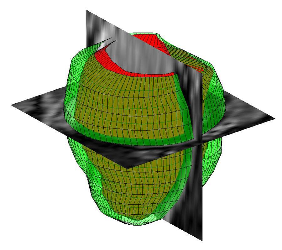 基于MATLAB的磁共振图像左心室三维几何重建。