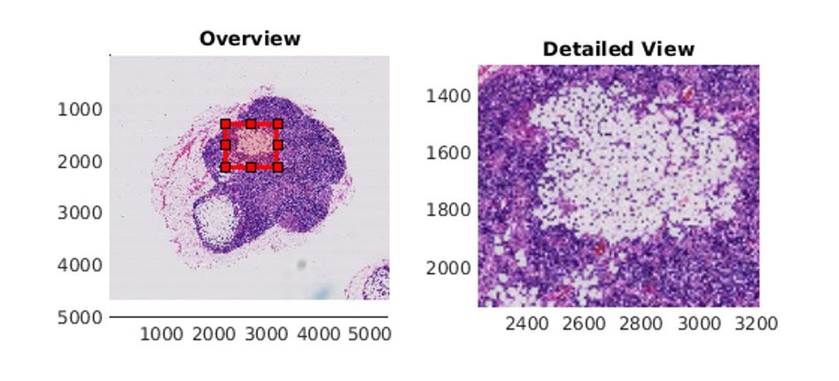 在MATLAB中用<code>bigimageshow</code>显示包含肿瘤组织的淋巴结图像。