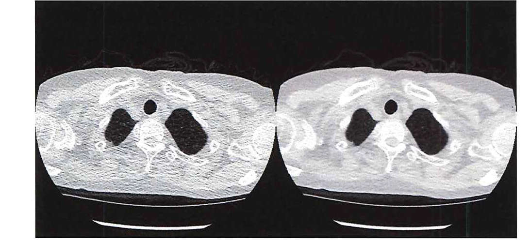 図1。超低線量CT(左)と従来のCT(右)の画質の比較