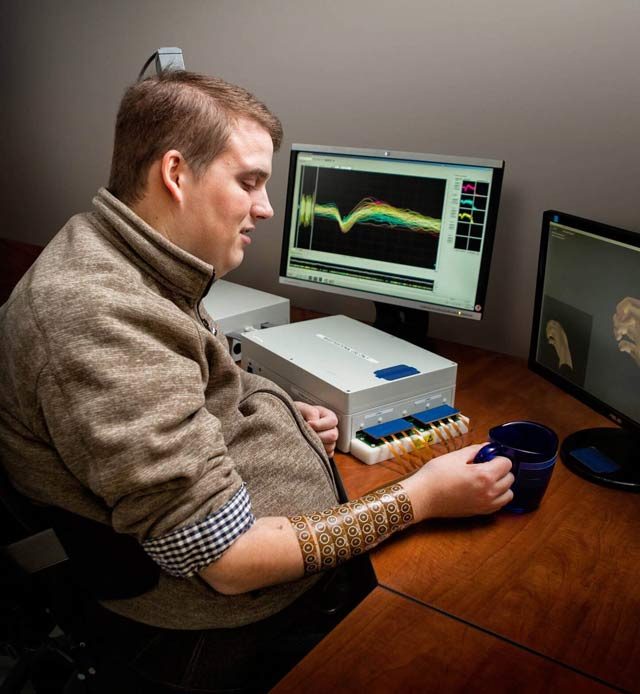 巴特尔神经旁路技术恢复瘫痪人的手臂和手的运动